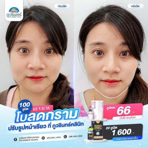 โบทอกซ์ | BTXA | Class Clinic (กังสดาล/หอกาญ) - Image 2