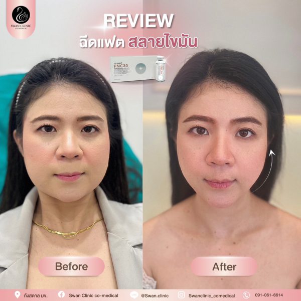 ฉีดสลายไขมัน | FNC30 Premium | SWAN CLINIC (กังสดาล) - Image 2