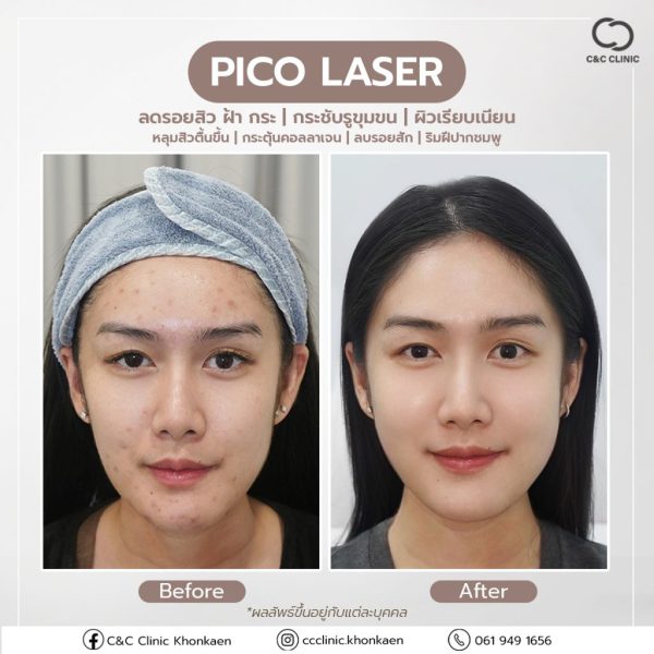 เลเซอร์ | รอยดำ รอยแดง ฟ้า กระ หลุมสิว | C&C Clinic (กังสดาล) - Image 2