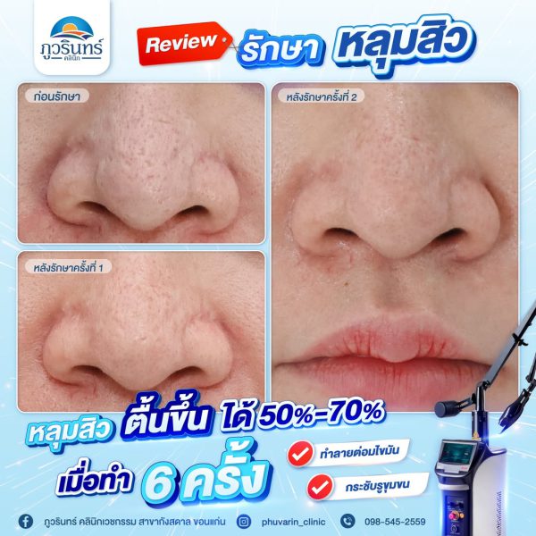 เลเซอร์ | หลุมสิว | ภูวรินทร์คลินิกเวชกรรม (กังสดาล) - Image 2