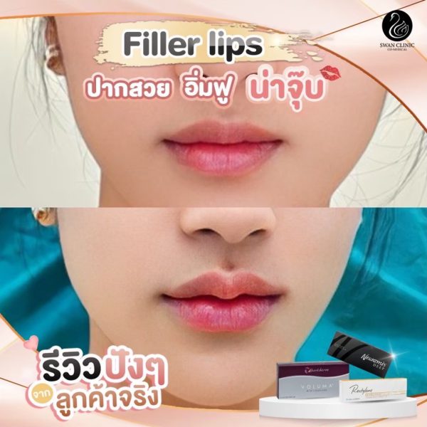 ฟิลเลอร์ | Juvederm | SWAN CLINIC (กังสดาล) - Image 2