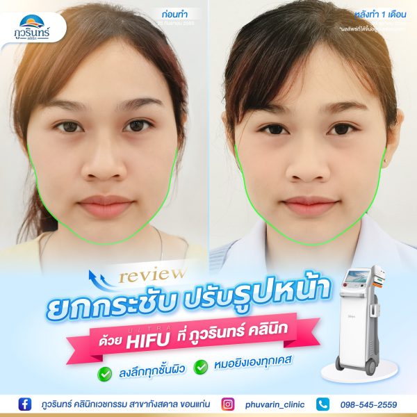 การยกกระชับปรับรูปใบหน้า | Linear Hifu | ภูวรินทร์คลินิกเวชกรรม (กังสดาล) - Image 2