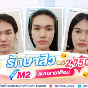 รักษาสิวแบบรายเดือน คอร์ส M2 | ภูวรินทร์คลินิกเวชกรรม (กังสดาล)