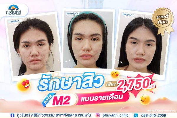 การยกกระชับปรับรูปใบหน้า | Linear Hifu | ภูวรินทร์คลินิกเวชกรรม (กังสดาล) - Image 4
