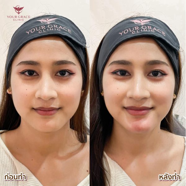 ฟิลเลอร์ | Neuramis | Your Grace Clinic (กังสดาล) - Image 3