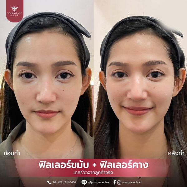 ฟิลเลอร์ | Juvederm | Your Grace Clinic (กังสดาล) - Image 3