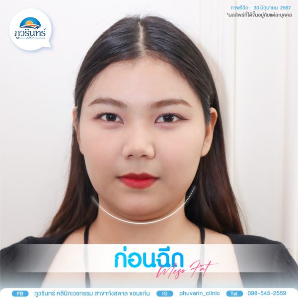 โบทอกซ์ | NABOTA |  | ภูวรินทร์คลินิกเวชกรรม (กังสดาล) - Image 2