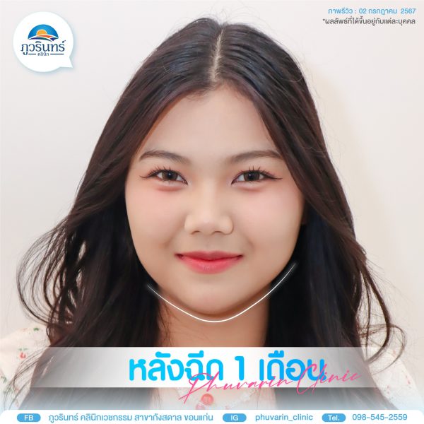 โบทอกซ์ | NABOTA |  | ภูวรินทร์คลินิกเวชกรรม (กังสดาล) - Image 3