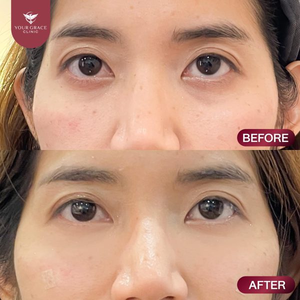 ฟิลเลอร์ | Restylane | Your Grace Clinic (กังสดาล) - Image 3