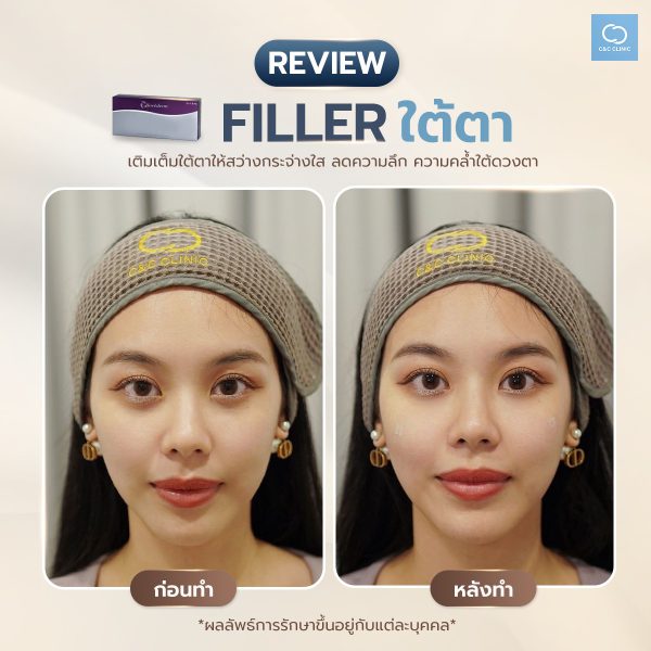 ฟิลเลอร์ | Juvederm | C&C Clinic (กังสดาล) - Image 2