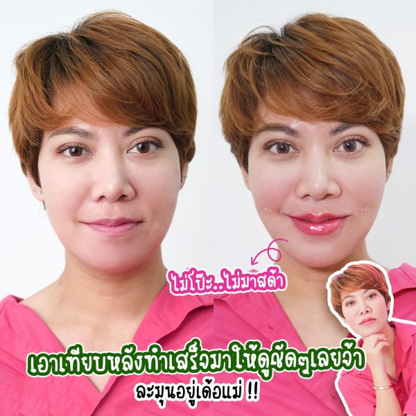 ฟิลเลอร์ | Restylane  | Wandee Clinic (กังสดาล) - Image 2