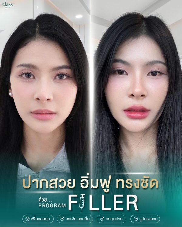 ฟิลเลอร์ | Juvederm | Class Clinic (กังสดาล/หอกาญ) - Image 2
