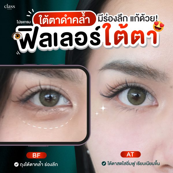 ฟิลเลอร์ | Juvederm | Class Clinic (กังสดาล/หอกาญ) - Image 3