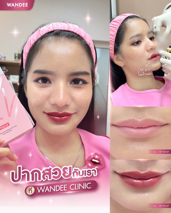 ฟิลเลอร์ | Ultra V  | Wandee Clinic (กังสดาล) - Image 5