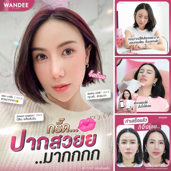 ฟิลเลอร์ | Ultra V  | Wandee Clinic (กังสดาล) - Image 2