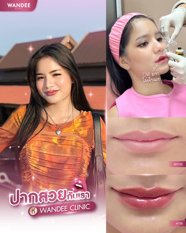 ฟิลเลอร์ | Ultra V  | Wandee Clinic (กังสดาล) - Image 6