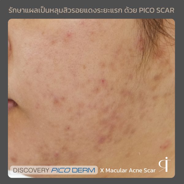 เลเซอร์ รอยสิว ฝ้า กระตื้น ริมฝีปากหมองคล้ำ หลุมสิว | Discovery Pico Laser | RIT CLINIC (กังสดาล) - Image 8