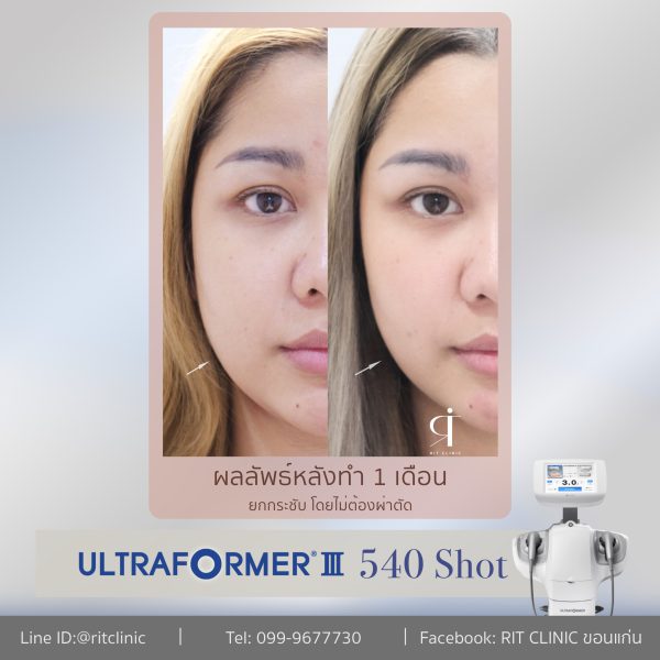 ยกกระชับปรับรูปหน้า | ULTRA FORMER III | RIT Clinic (กังสดาล) - Image 2