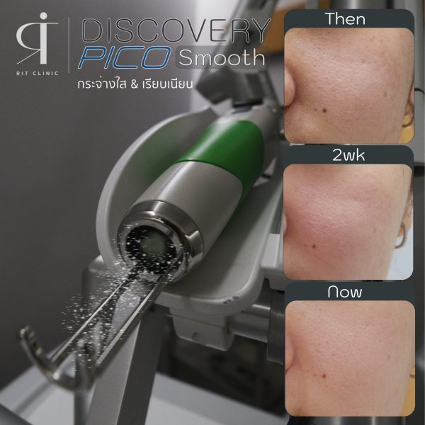 เลเซอร์ รอยสิว ฝ้า กระตื้น ริมฝีปากหมองคล้ำ หลุมสิว | Discovery Pico Laser | RIT CLINIC (กังสดาล) - Image 7