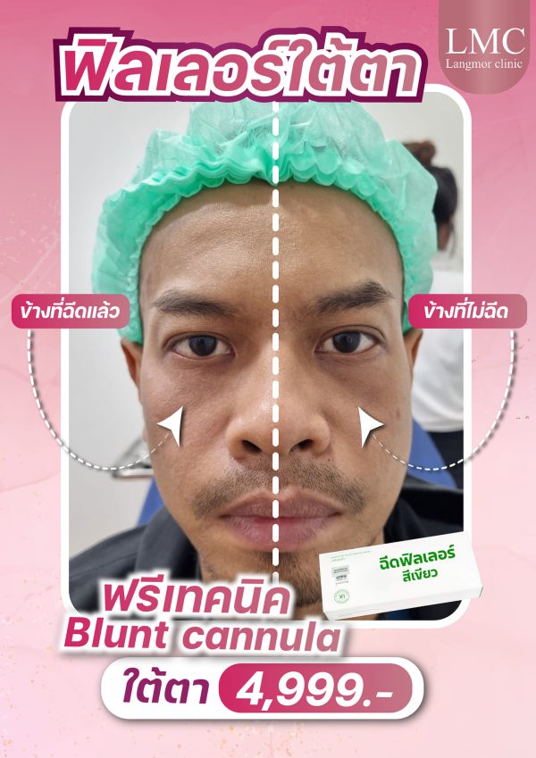 ฟิลเลอร์ | e.p.t.q | The Ben Clinic (หลังมอ) - Image 2