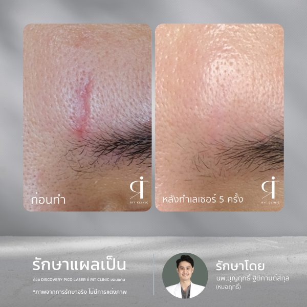 เลเซอร์ รอยสิว ฝ้า กระตื้น ริมฝีปากหมองคล้ำ หลุมสิว | Discovery Pico Laser | RIT CLINIC (กังสดาล) - Image 5