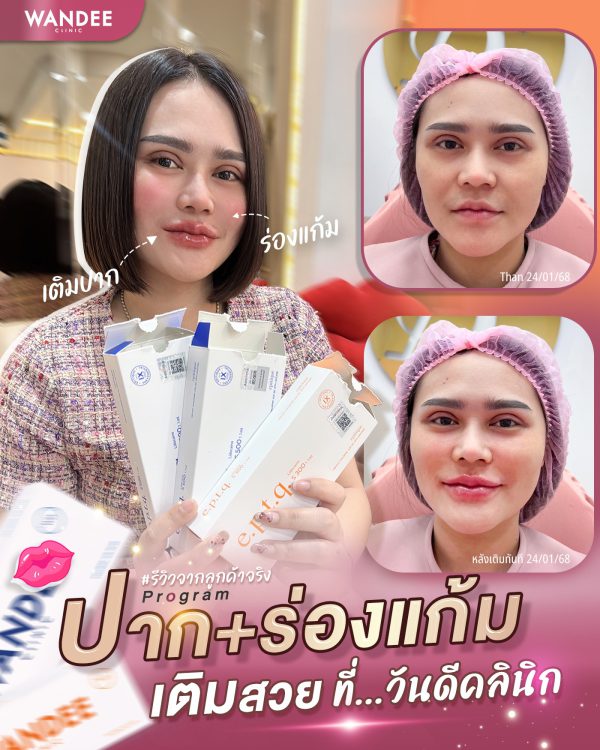 ฟิลเลอร์ | e.p.t.q | Wandee Clinic (กังสดาล) - Image 2