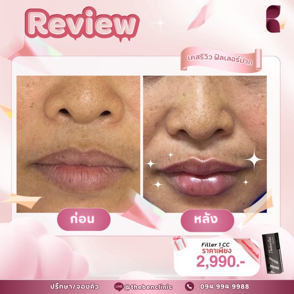 ฟิลเลอร์ | Neuramis | The Ben Clinic (หลังมอ) - Image 7