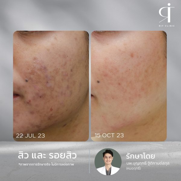 เลเซอร์ รอยสิว ฝ้า กระตื้น ริมฝีปากหมองคล้ำ หลุมสิว | Discovery Pico Laser | RIT CLINIC (กังสดาล) - Image 6