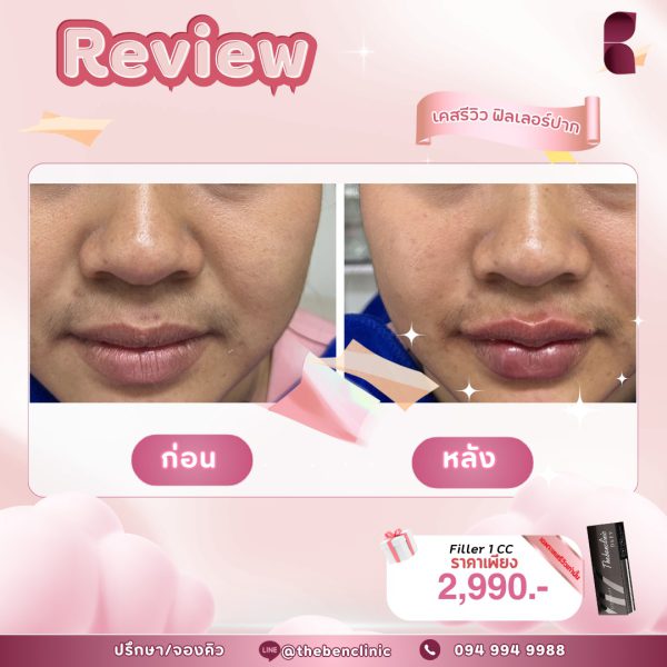 ฟิลเลอร์ | Neuramis | The Ben Clinic (หลังมอ) - Image 3