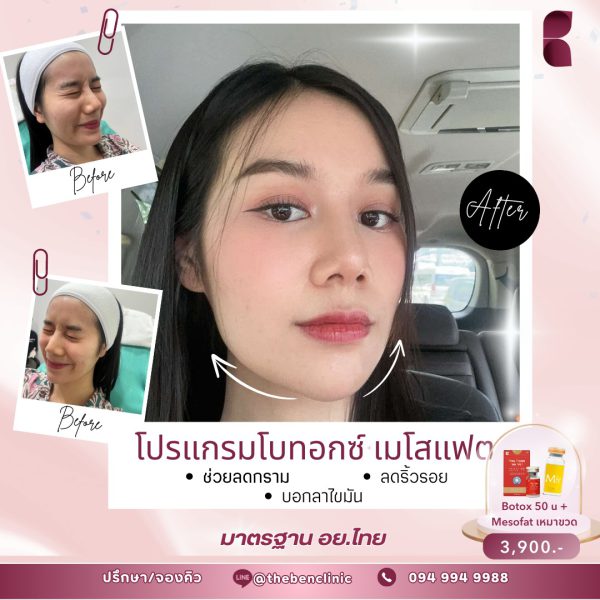ฟิลเลอร์ | Neuramis | The Ben Clinic (หลังมอ) - Image 2