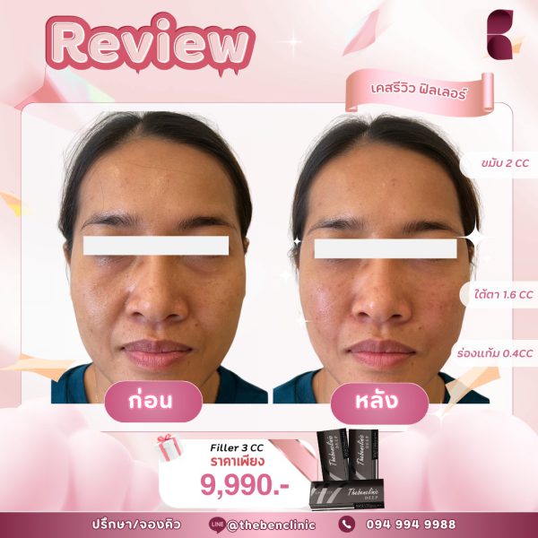 ฟิลเลอร์ | Neuramis | The Ben Clinic (หลังมอ) - Image 4