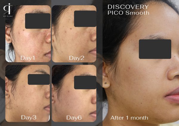เลเซอร์ รอยสิว ฝ้า กระตื้น ริมฝีปากหมองคล้ำ หลุมสิว | Discovery Pico Laser | RIT CLINIC (กังสดาล) - Image 4