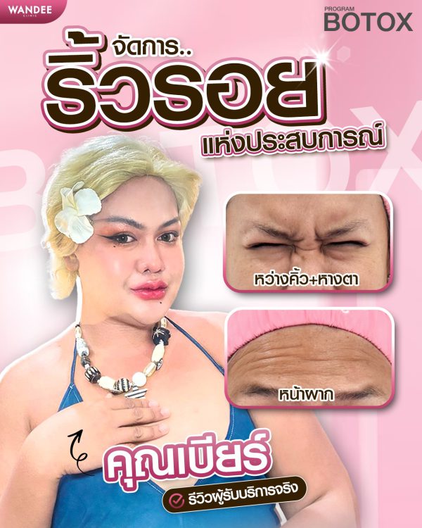 โบทอกซ์ | NABOTA | Wandee Clinic (กังสดาล) - Image 5