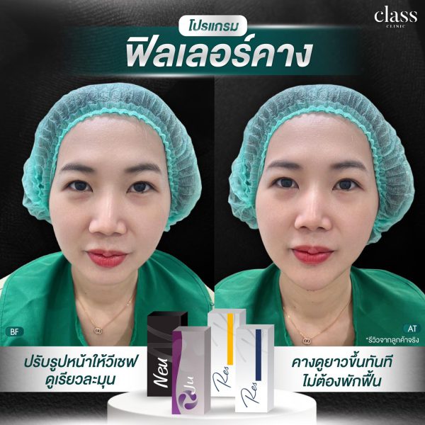 ฟิลเลอร์ | Restylane | Class Clinic (กังสดาล/หอกาญ) - Image 4