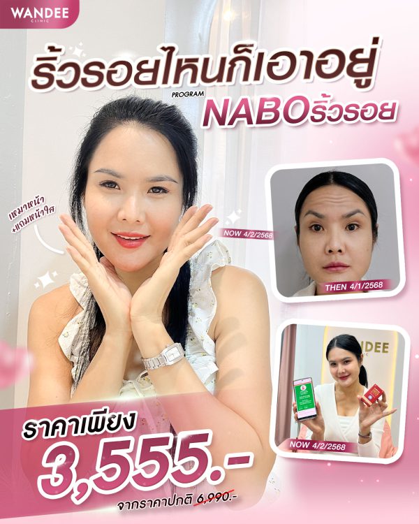 โบทอกซ์ | NABOTA | Wandee Clinic (กังสดาล) - Image 2