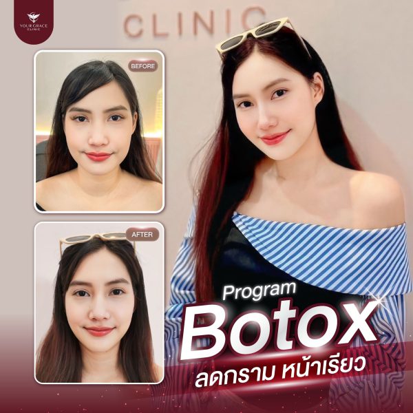 โบทอกซ์ | Aestox | Your Grace Clinic (กังสดาล) - Image 2