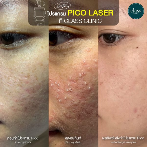 เลเซอร์ | รอยดำ รอยแดง ฟ้า กระ | Class Clinic (กังสดาล/หอกาญ) - Image 3