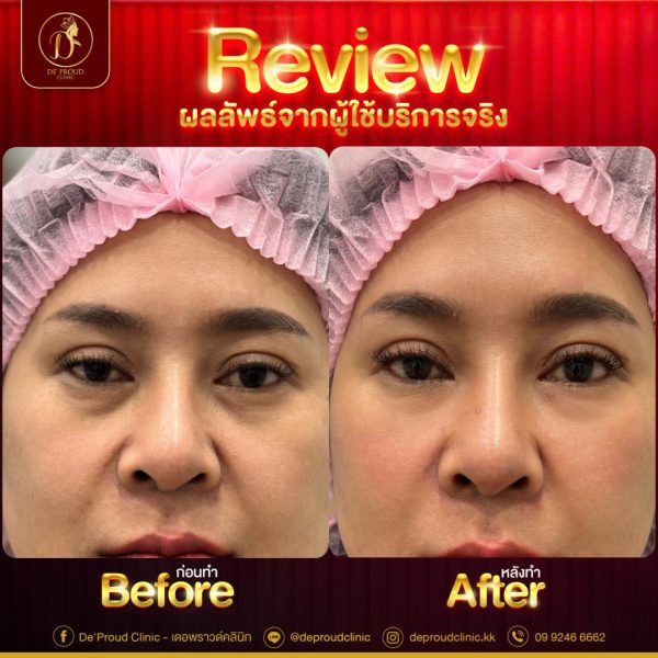 ฟิลเลอร์ | Neuramis | De’Proud Clinic (หลังมอ) - Image 2