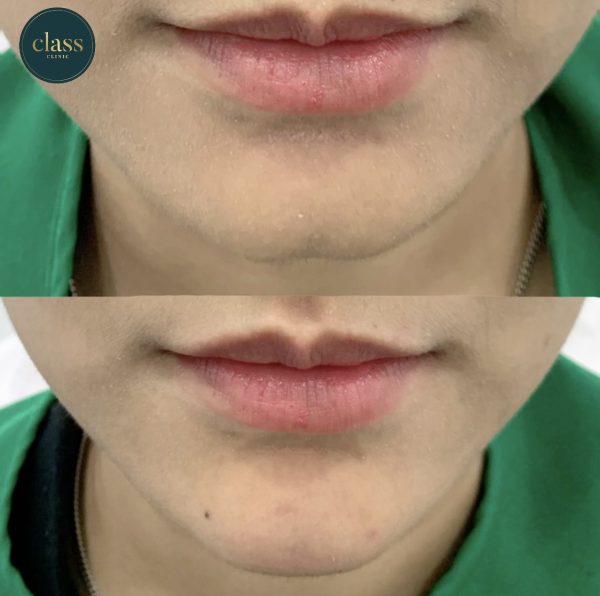ฟิลเลอร์ | Restylane | Class Clinic (กังสดาล/หอกาญ) - Image 3