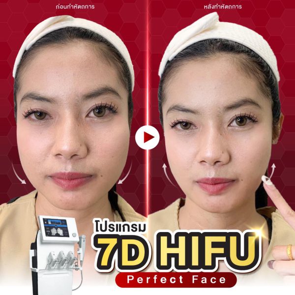 ยกกระชับใบหน้า | เครื่อง Hifu 7D Ultramax | De’Proud Clinic (หลังมอ) - Image 2
