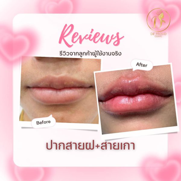 ฟิลเลอร์ | e.p.t.q | De’Proud Clinic (หลังมอ) - Image 2