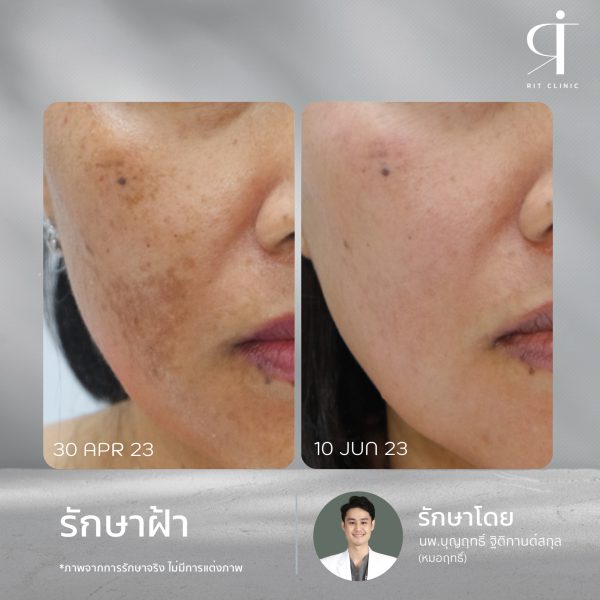 เลเซอร์ รอยสิว ฝ้า กระตื้น ริมฝีปากหมองคล้ำ หลุมสิว | Discovery Pico Laser | RIT CLINIC (กังสดาล) - Image 3
