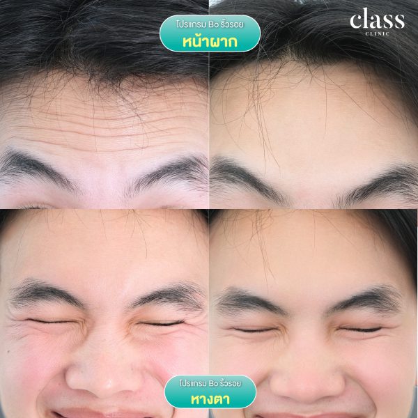 โบทอกซ์ | NEURONOX | Class Clinic (กังสดาล/หอกาญ) - Image 2