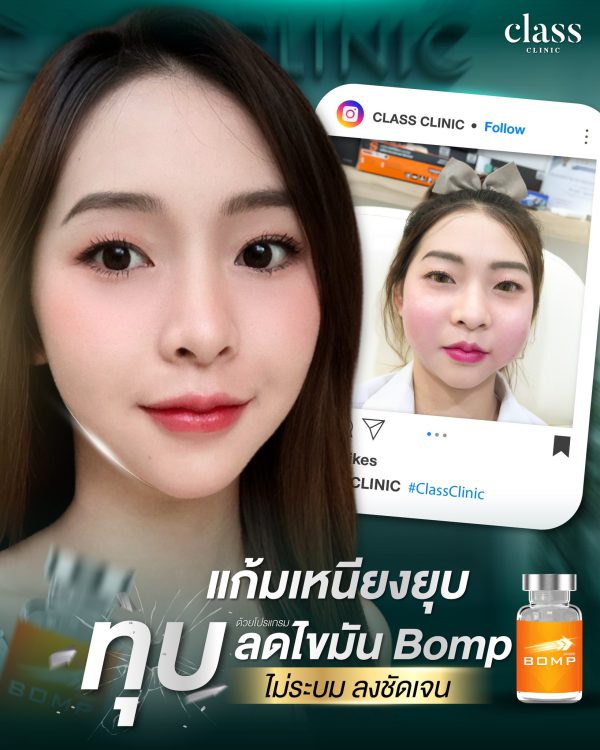 Lipo V Bomp | ฉีดสลายไขมัน | Class Clinic (กังสดาล/หอกาญ) - Image 2