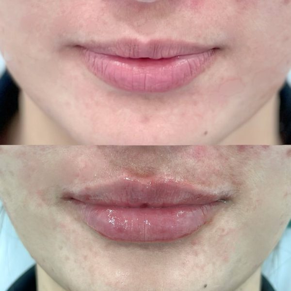 ฟิลเลอร์ | e.p.t.q | | Class Clinic (กังสดาล/หอกาญ) - Image 2