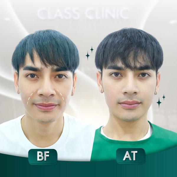 ฟิลเลอร์ | e.p.t.q | | Class Clinic (กังสดาล/หอกาญ) - Image 3