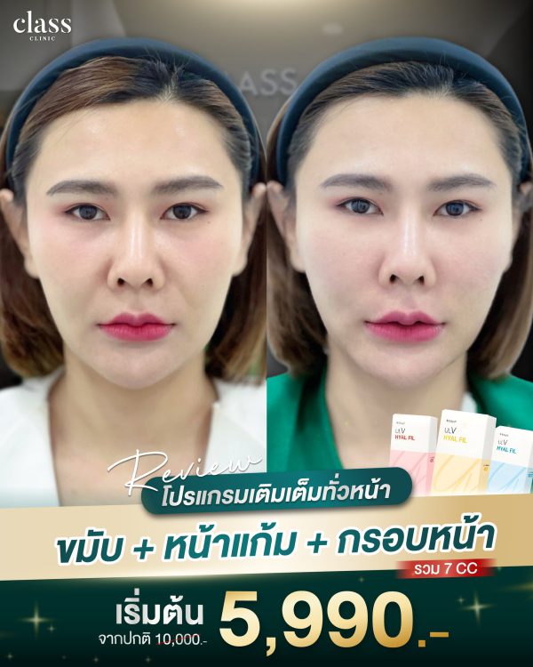 ฟิลเลอร์ | Ultra V | | Class Clinic (กังสดาล/หอกาญ) - Image 3