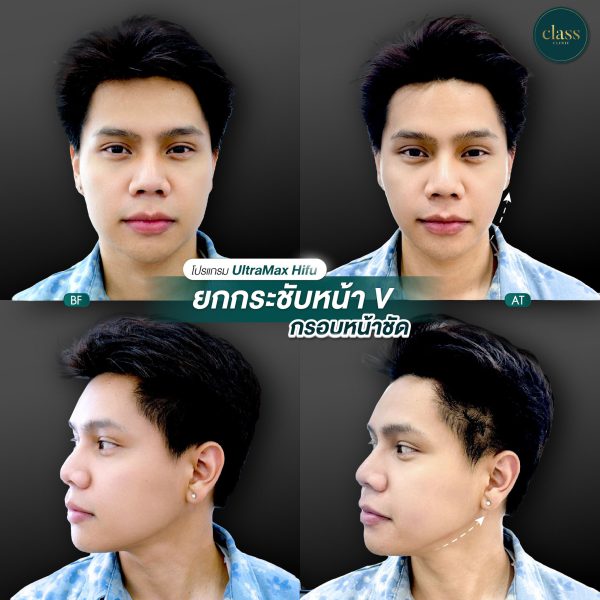การยกกระชับใบหน้า | เครื่อง Ultramax | Class Clinic (กังสดาล/หอกาญ) - Image 2