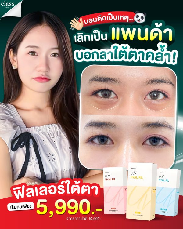 ฟิลเลอร์ | Ultra V | | Class Clinic (กังสดาล/หอกาญ) - Image 2