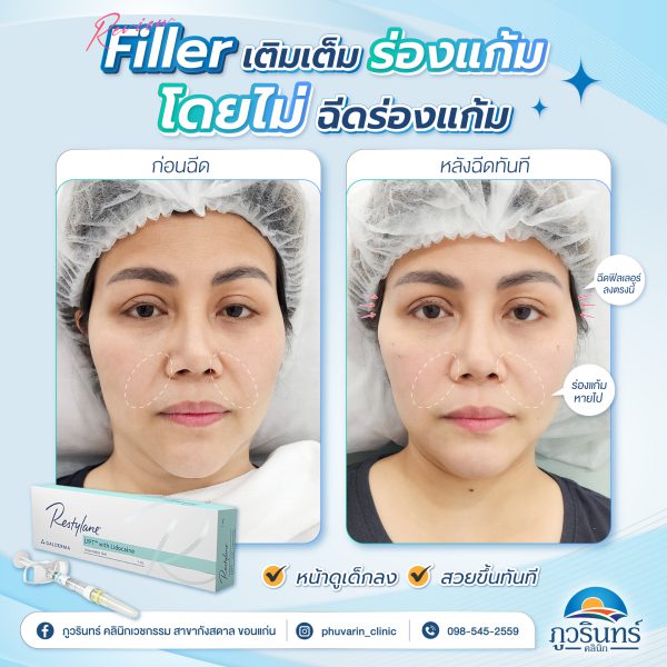 ฟิลเลอร์ | Restylane | Class Clinic (กังสดาล/หอกาญ) - Image 2